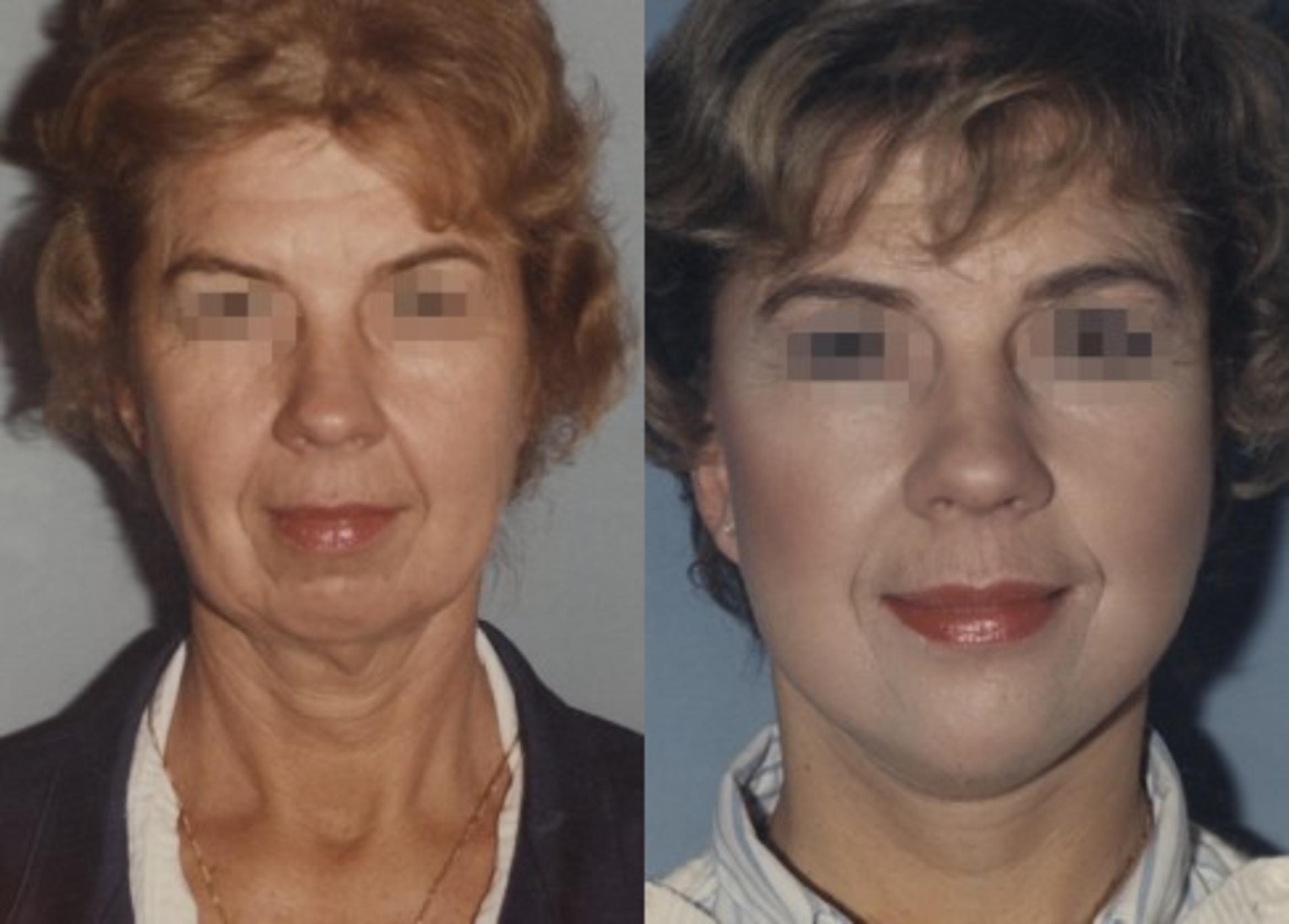 Face / Neck Lift Before & After Photo | New Jersey & Pennsylvania,  | The Derm Group