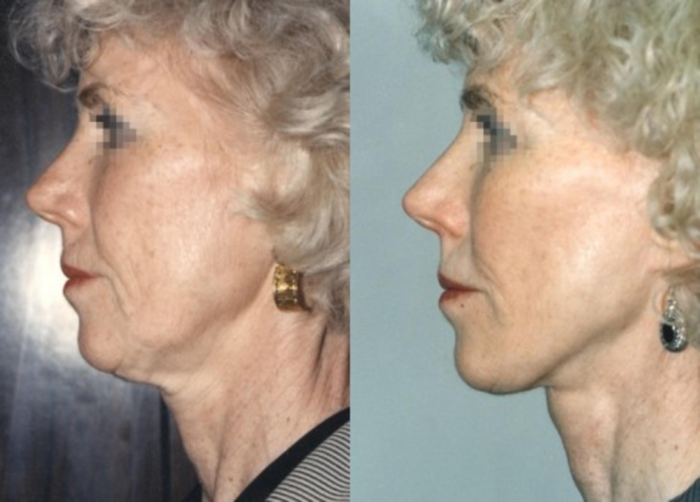 Face / Neck Lift Before & After Photo | New Jersey & Pennsylvania,  | The Derm Group