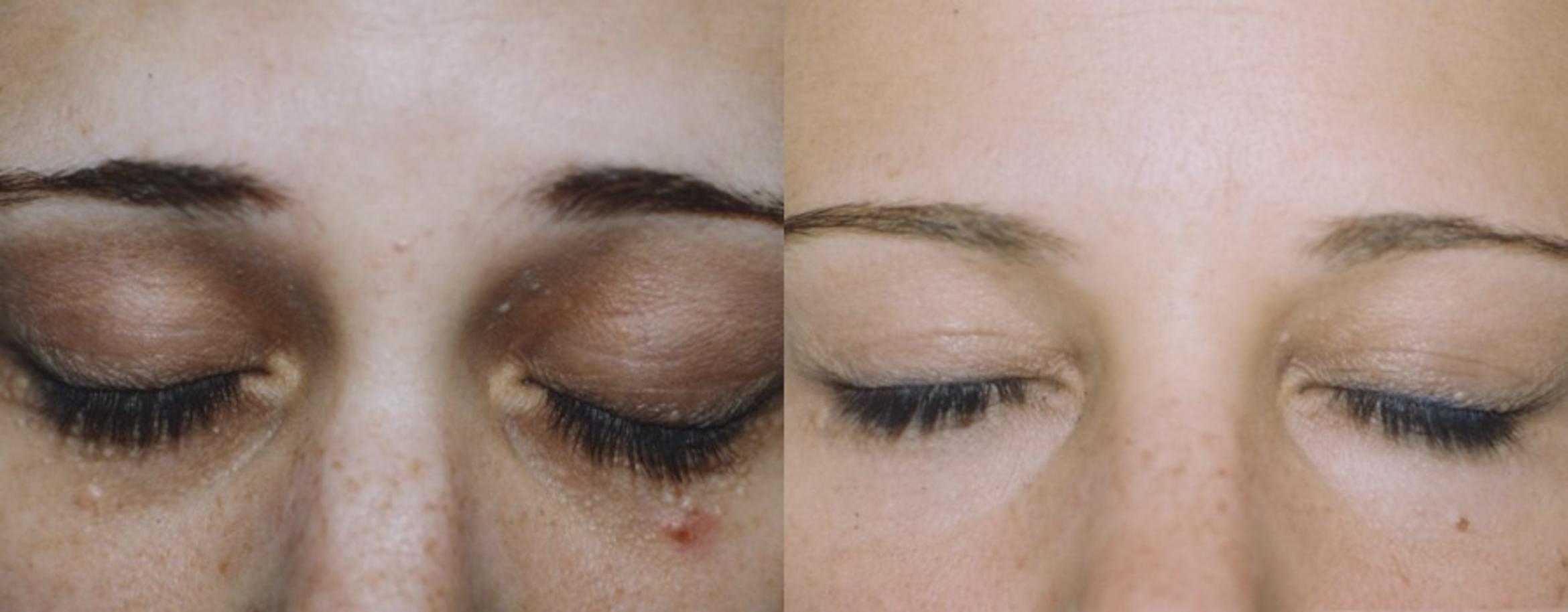 Facial Rejuvenation  Before & After Photo | New Jersey & Pennsylvania,  | The Derm Group