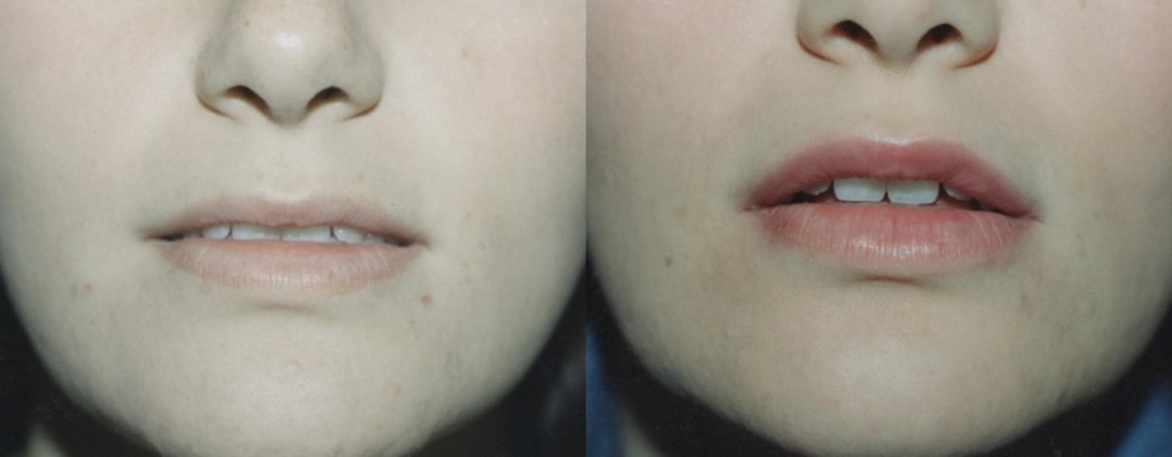 Fat Injection Before & After Photo | New Jersey & Pennsylvania,  | The Derm Group