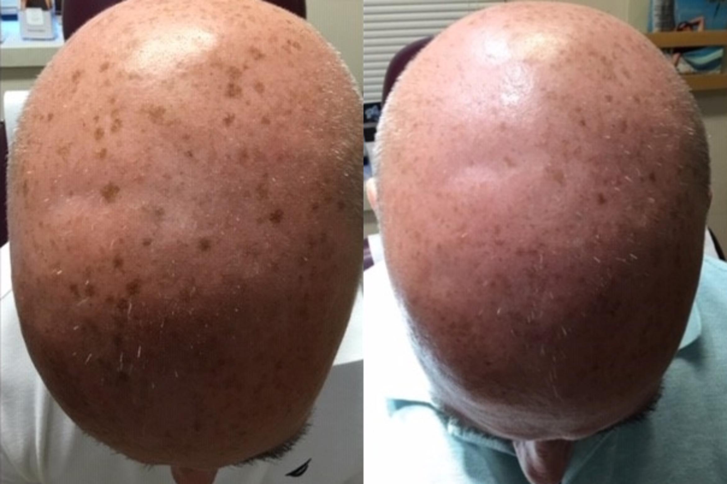 Laser Sunspot Removal Before & After Photo | New Jersey & Pennsylvania,  | The Derm Group