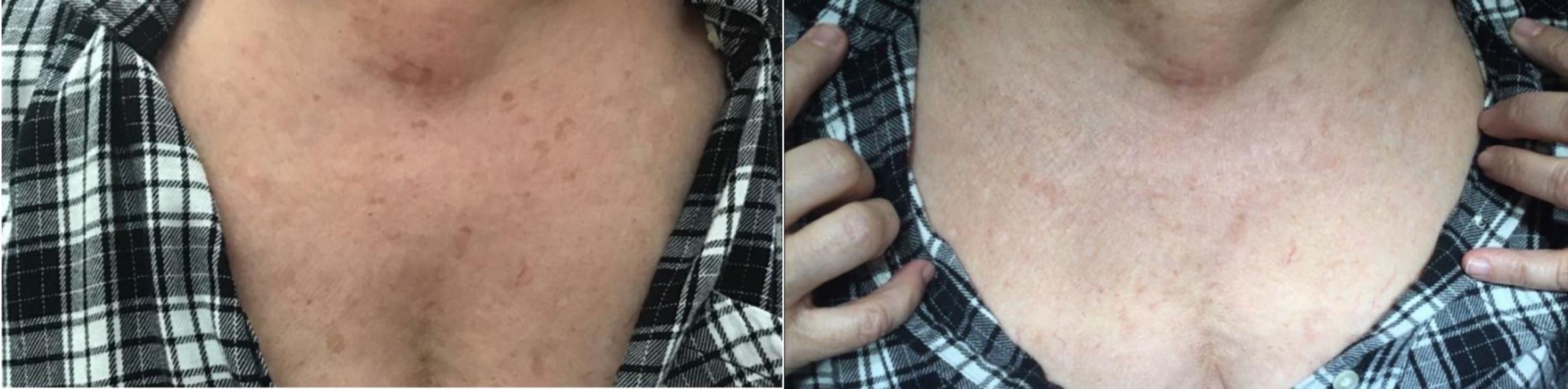 Laser Sunspot Removal Before & After Photo | New Jersey & Pennsylvania,  | The Derm Group