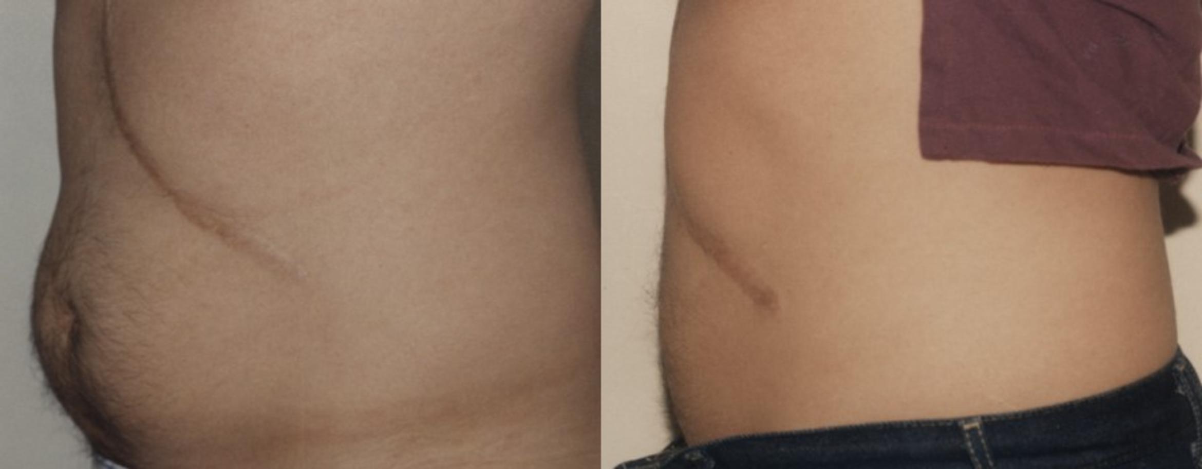 Liposuction Before & After Photo | New Jersey & Pennsylvania,  | The Derm Group