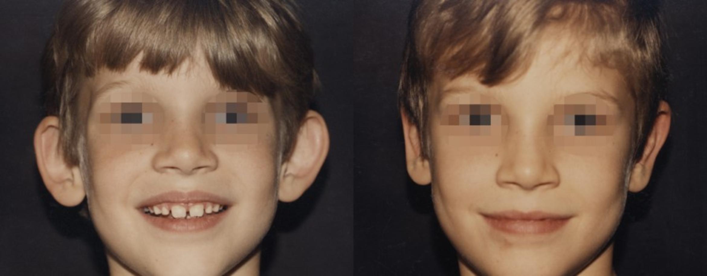 Otoplasty Before & After Photo | New Jersey & Pennsylvania,  | The Derm Group