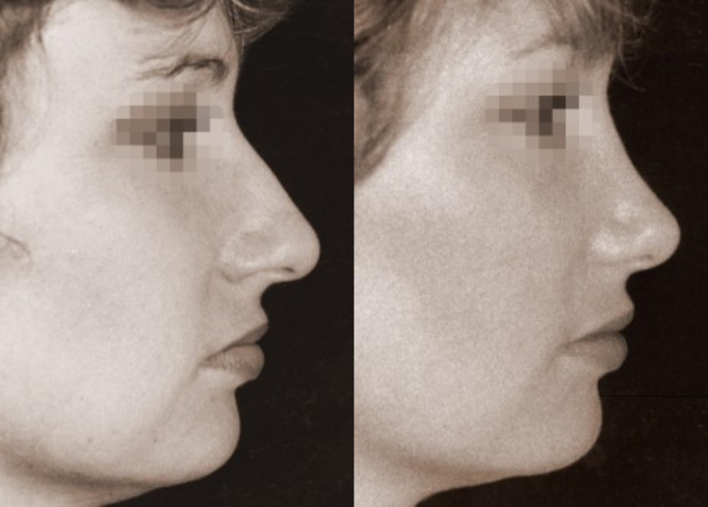 Rhinoplasty Before & After Photo | New Jersey & Pennsylvania,  | The Derm Group