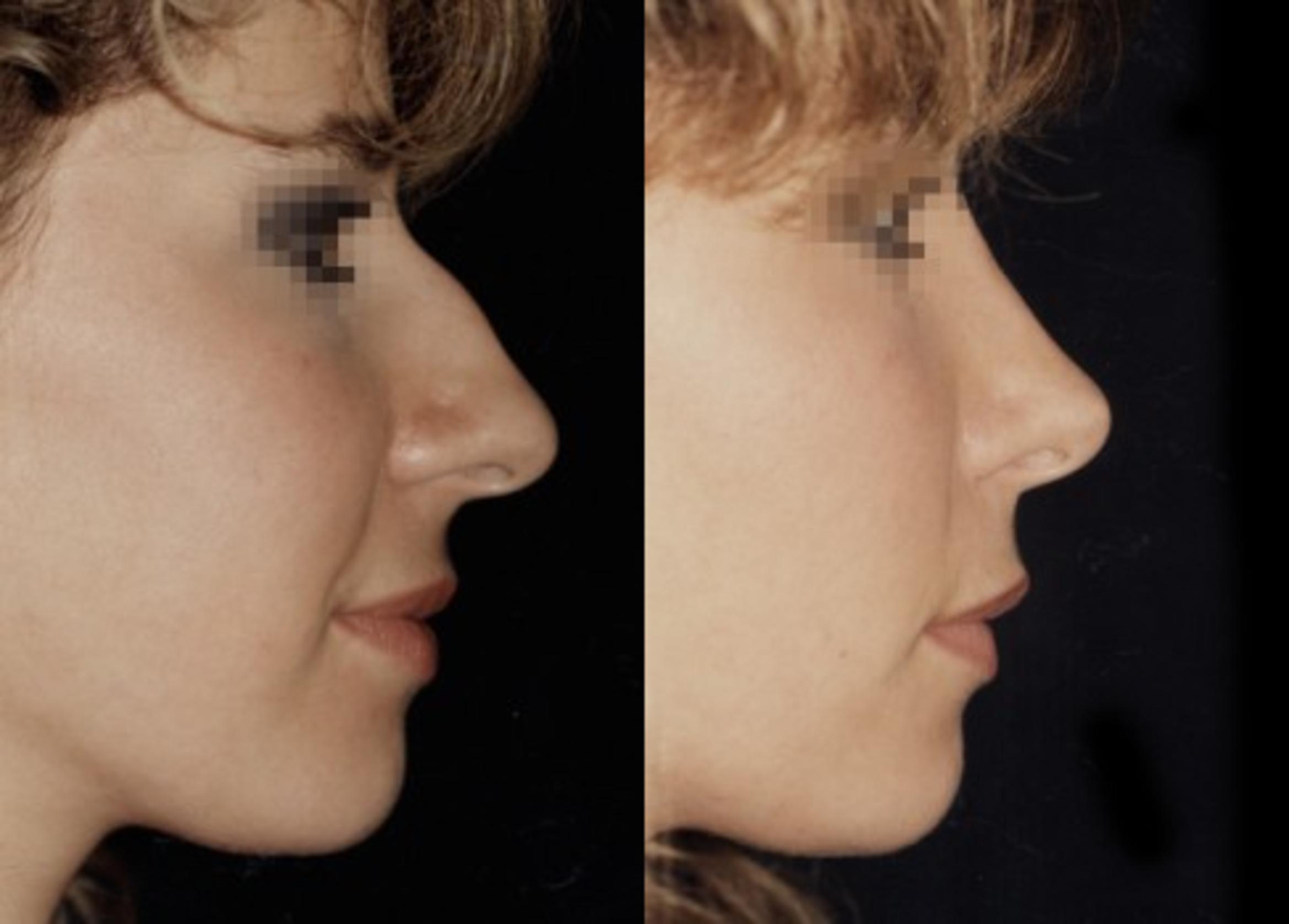 Rhinoplasty Before & After Photo | New Jersey & Pennsylvania,  | The Derm Group