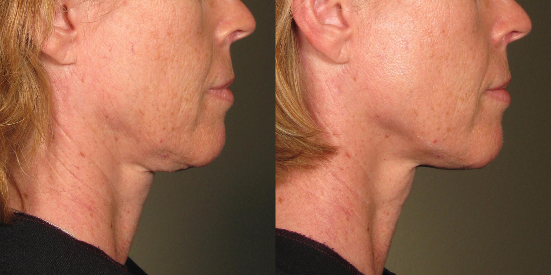 Ultherapy® Before & After Photo | New Jersey & Pennsylvania,  | The Derm Group