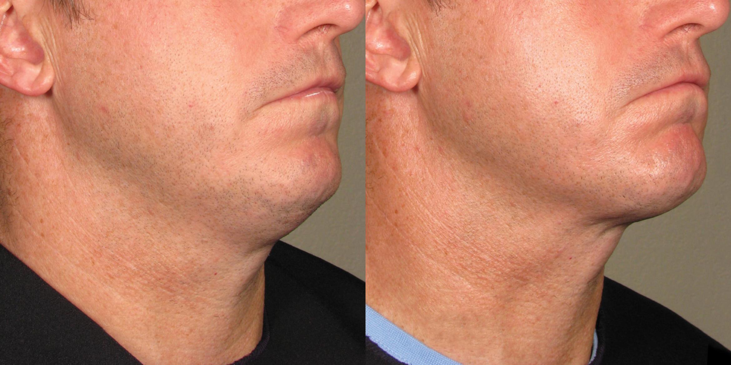 Ultherapy® Before & After Photo | New Jersey & Pennsylvania,  | The Derm Group