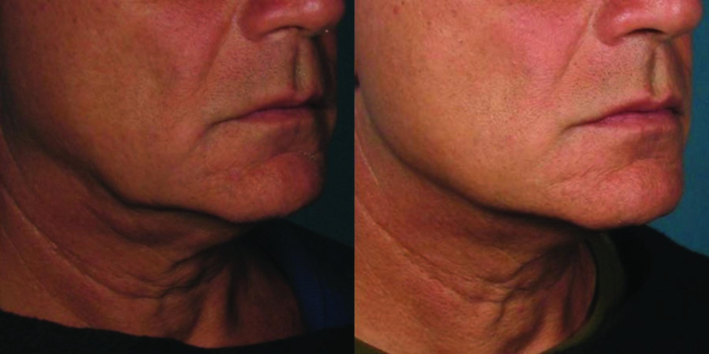 Ultherapy® Skin Tightening | The Derm Group